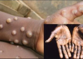 FULL LIST: Monkeypox Spreads To 26 States In Nigeria