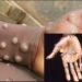 FULL LIST: Monkeypox Spreads To 26 States In Nigeria