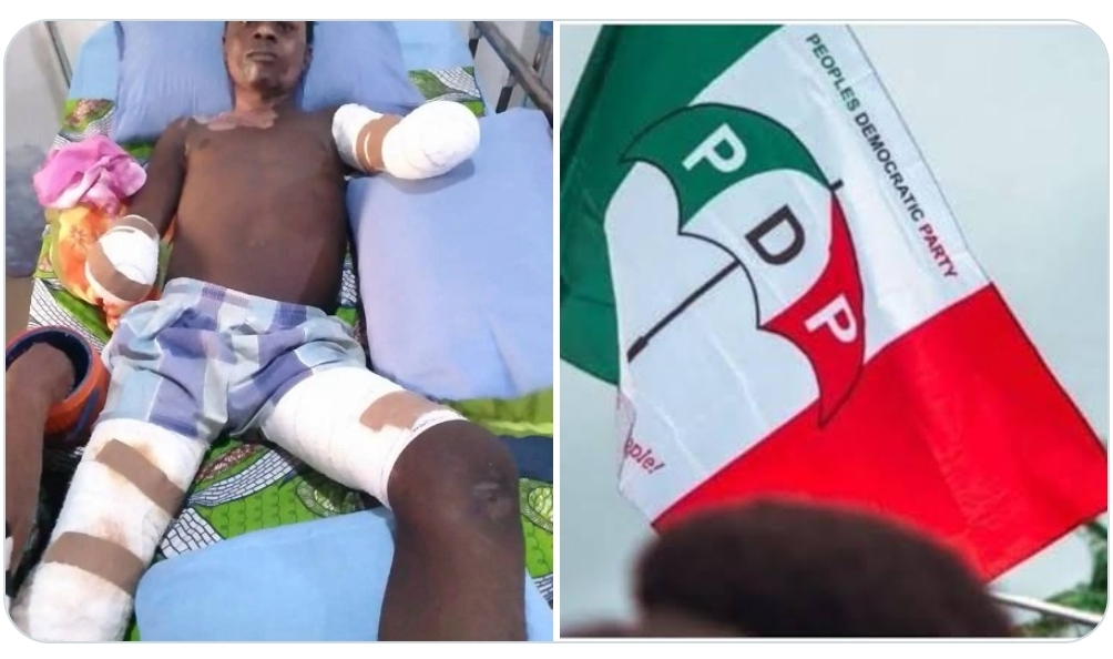 Polytechnic Student Loses Both Hands While Hoisting PDP Flag